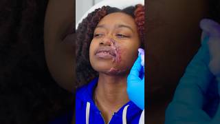 Plastic Surgery Changed Her Life - Acid Attack Survivor Shares Her Story