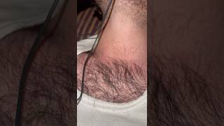 Clearly hair loss problem #hair #hairsalon #hairandbeard #hairstyle #barbersurgion