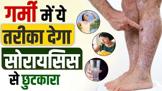 गर्मी में सोरायसिस से बचने का तरीका | Home Remedy For Psoriasis | How To Avoid Psoriasis In Summer