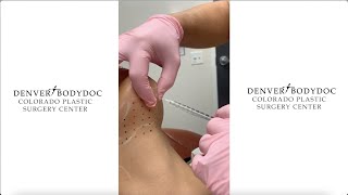 Kybella - Double Chin Treatment - Get Rid of Chin Fat - Patient Demonstration