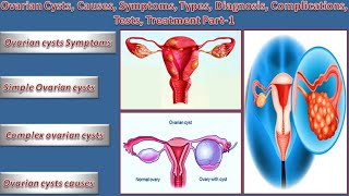 Ovarian Cysts, Causes, Symptoms, Types, Diagnosis, Complications, Tests, Treatment Part 1