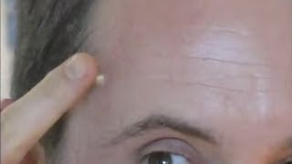 Spot treating a zit with 10% glyolic acid