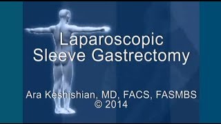 Laparoscopic Sleeve Gastrectomy