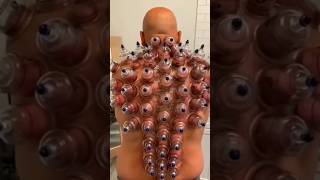 Cupping therapy #shorts #viral