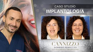 Implantologia Fissa: Caso Studio Dottore Cannizzo