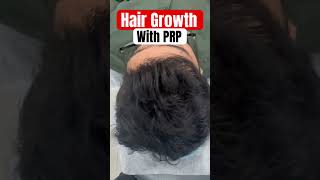 Hair Growth after PRP #hairloss #hair