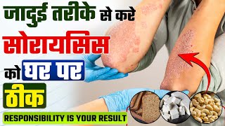 घर पर सोरायसिस का इलाज | Skin allergy treatment | सोरायसिस (छाल रोग) के घरेलू उपाय