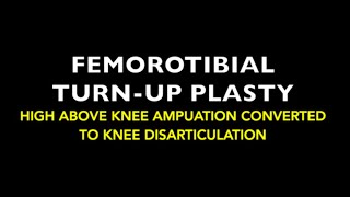 Femorotibial Turnup-plasty or Turnuplasty or Turn O plasty  Surgery for Bone Tumors