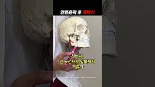 안면윤곽 개턱?! 해결방법 #shorts #plasticsurgeryinkorea