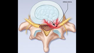 Probabilidade de regressão espontânea de uma hérnia de disco lombar