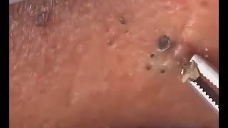 Many large blackheads are removed