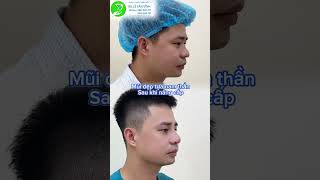 Nâng mũi cho Nam Giới - Thẩm Mỹ Khang Vĩnh