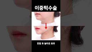 시간과 돈이 아깝습니다 #plasticsurgeryinkorea