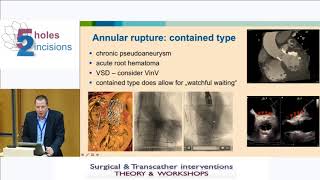 J  Kempfert  Complications in TAVI procedure