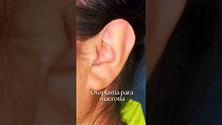 Otoplastia para macrotia: correção simples é eficaz.