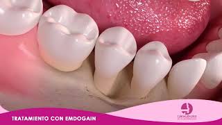 Emdogain - Periodoncia