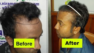 শুনুন ডাইরেক্ট Patient এর কাছ থেকে  | After Hair Transplant