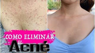 ❤️Como Eliminar El Acne ❤️Tips ❤️ Trucos ❤️Medicinas y Consejos❤️