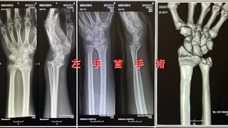 【バイク事故】左手首 粉砕 骨折 手術 入院 リハビリ