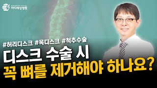 디스크 수술 시 꼭 뼈를 제거해야 하나요?