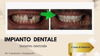 Impianto dentale su incisivo