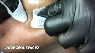 Extreme Blackhead Removal