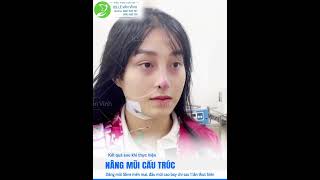 Nâng Mũi Cấu Trúc Có Đau Không - Thẩm Mỹ Khang Vĩnh