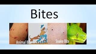 Human and animals bites(Human Bites is a worst)