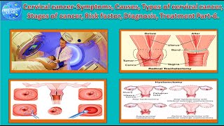 Cervical Cancer Symptoms, Causes, Types , Stages of cancer, Risk factor, Diagnosis,Treatment Part 6