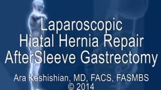 Laparoscopic Hiatal Hernia Repair after Sleeve Gastrectomy