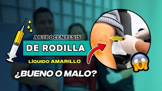 EXTRACCION DE LÍQUIDO AMARILLO EN LA RODILLA ¿ES BUENO O MALO? 👨🏻‍⚕️🦴