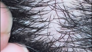 Ingrown hairs big problem removing | ingrown 10 ingrown asmr satisfying vedio beards