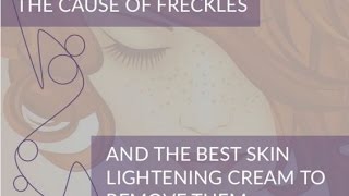 The Cause of Freckles and the Best Skin Lightening Cream to Remove Them