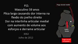 Quando uma PLICA provoca DOR NO JOELHO | Dr. Paulo Rockett