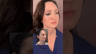 Facelift Saved Her Life! Emotional Plastic Surgery Transformation 🥺