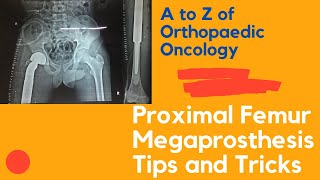 Proximal Femur Megaprosthesis Surgery : Hip Joint replacement surgery for Bone cancer