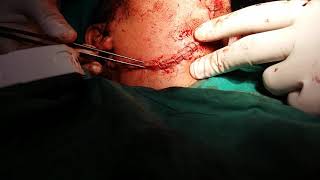 Skin stappling of incision in neck region and removal of stapple