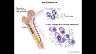 Multiple myeloma