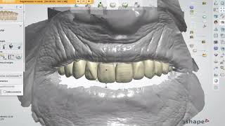 Peri-oral scans as a guide for denture design.