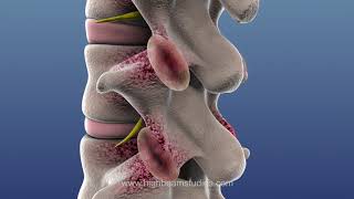 Facet Joint Syndrome