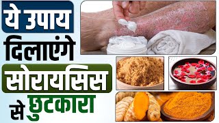 ये उपाय घर पर ही कर के पाएं अपने सोरायसिस से छुटकारा | Natural home remedies for skin psoriasis