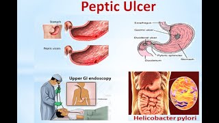 Peptic Ulcer