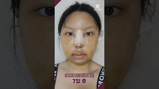 다시 태어난 것만 같아요🫢#plasticsurgeryinkorea