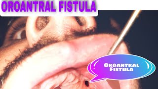 Oroantral Fistula