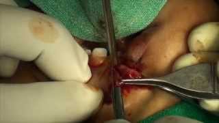 White-Roll Vermilion turn down flap for U/L Lip repair - Mishra's Technique