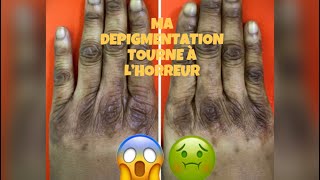 Ma dépigmentation tourne à l’horreur