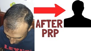 PRP Results 2020 | Hair loss Treatment | Hair Fall