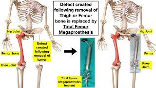 Total Femur Bone Replacement surgery : Hip Joint , Knee Joint and Thigh Bone Replacement Surgery