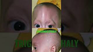 trigonocephaly