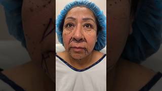 64 Year Old Facelift Transformation 🤯